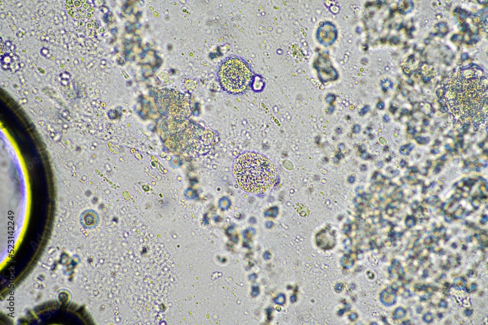 Coughing up mucus and phlegm from a chest infection from a virus and ...