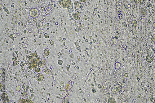 Coughing up mucus and phlegm from a chest infection from a virus and bacteria infection, looking at it under the microscope, with cells and microorganisms. Bacteria and skin cells close up