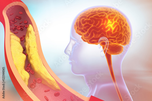 Carotid Artery Problems, Brain stroke. clogged veins with human brain. 3d illustration. #523144065
