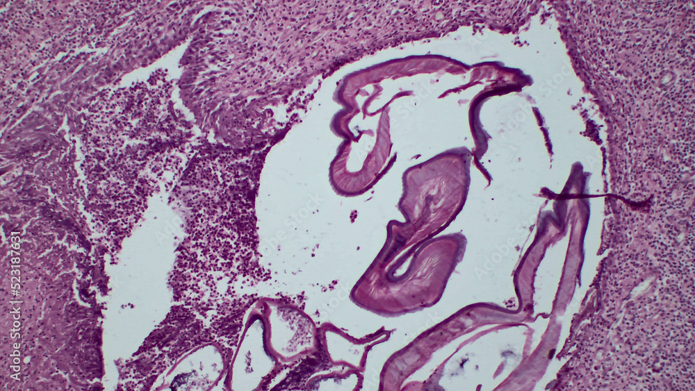 Parasitic flatworms in humans. Cross-sections of Dirofilaria spp. from a subcutaneous scalp nodule. 