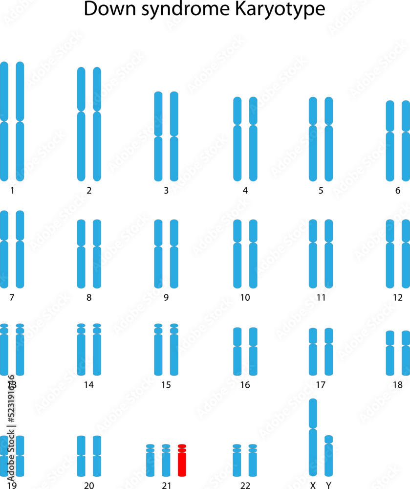 Vecteur Stock Down syndrome (trisomy 21) human karyotype Adobe Stock