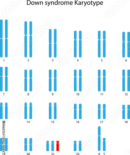Down syndrome (trisomy 21) human karyotype