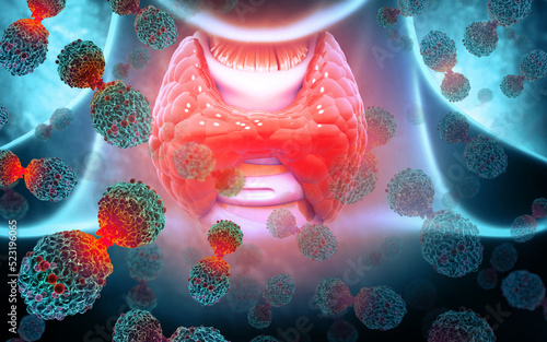 Thyroid gland cancer. Cancer cells attacking the thyroid gland. 3d illustration photo