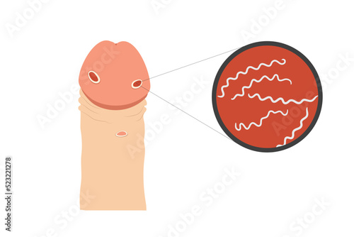 Medical chart of penis and syphilitic ulcers on its skin. Spiral bacterias in the microscope lens shown.