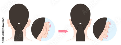 Back view of Ear pinned reshape Corrective lop earlobes deformities