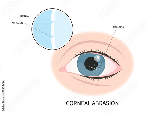 conjunctival cyst swelling and pink red surfer's eye blurry ulcer bacteria lens vision loss pain sores tear drop scars trauma itchy dry uvea Stye injury
hordeolum pimple cellulitis pupil iris Anterior