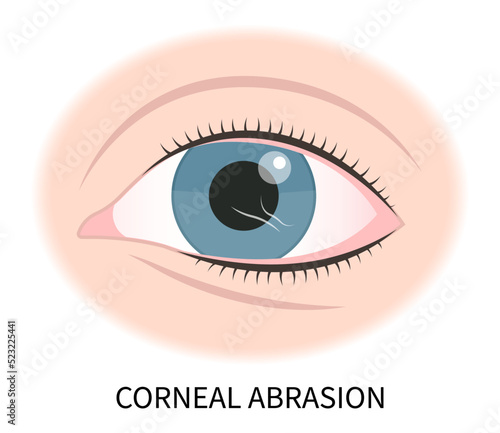 eye pimple and cellulitis pink red surfer's blurry ulcer bacteria lens vision loss pain sores tear drop scars trauma conjunctival cyst swelling itchy dry uvea Stye injury
hordeolum pupil iris Anterior