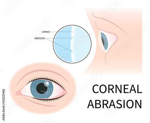 eye tear drop scars trauma pink red surfer's blurry ulcer bacteria lens vision loss pain sores conjunctival cyst swelling itchy dry uvea Stye injury
hordeolum pimple cellulitis pupil iris Anterior