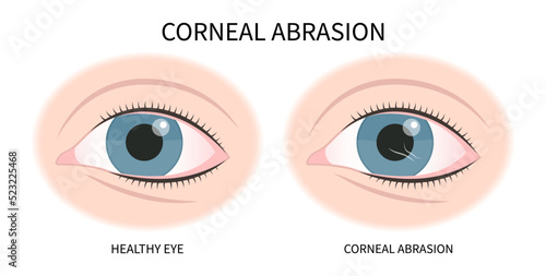 eye lens injury pink red surfer's blurry ulcer bacteria vision loss pain sores tear drop scars trauma conjunctival cyst swelling itchy dry uvea Stye hordeolum pimple cellulitis pupil iris Anterior photo