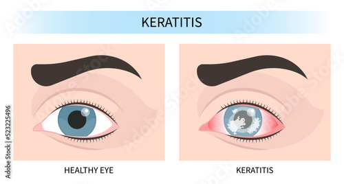 pupil iris scars injury pink red surfer's eye blurry ulcer bacteria lens vision loss pain sores tear drop trauma conjunctival cyst swelling itchy dry uvea Stye hordeolum pimple cellulitis Anterior photo