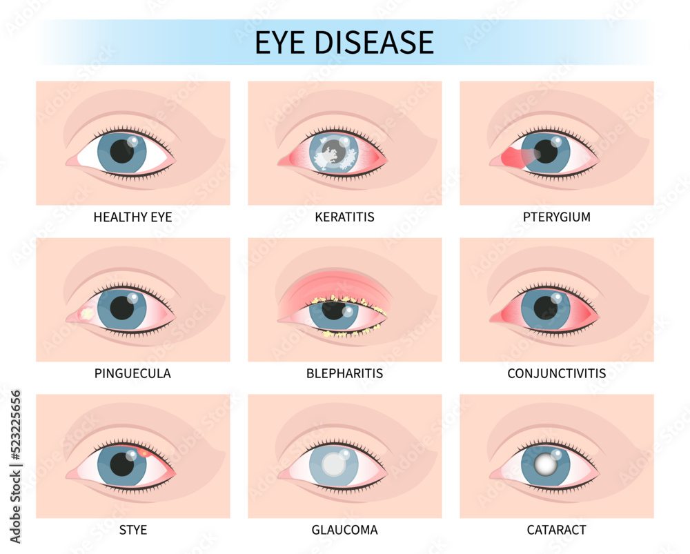 Stye eye lens injury pink red surfer's blurry ulcer bacteria vision