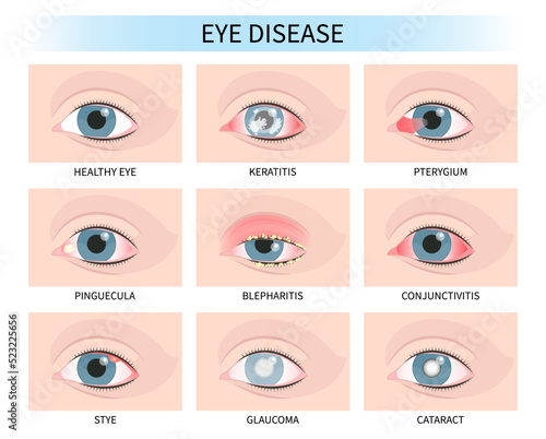 Stye eye lens injury pink red surfer's blurry ulcer bacteria vision loss pain sores tear drop scars trauma conjunctival cyst swelling itchy dry uvea hordeolum pimple cellulitis pupil iris Anterior	 photo