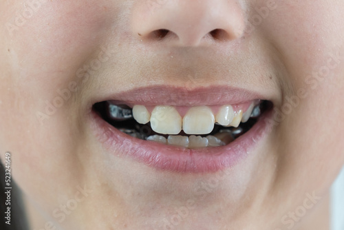 a little girl with a shifted dentition demonstrates her teeth