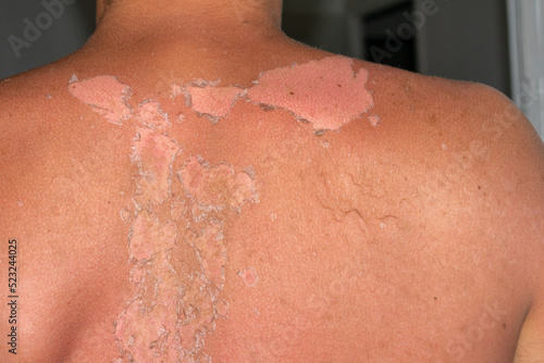 Εκτύπωση καμβά Peeling skin from a sunburn