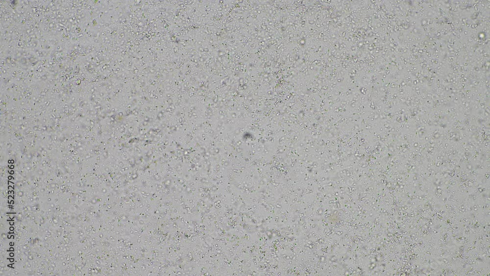 Sperm under the microscope. Looking a semen swimming. Healthy fertile man high sperm count Sperm under the microscope. Looking a semen swimming. Healthy fertile man high sperm count