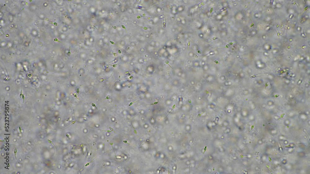 Sperm under the microscope. Looking a semen swimming. Healthy fertile man high sperm count Sperm under the microscope. Looking a semen swimming. Healthy fertile man high sperm count