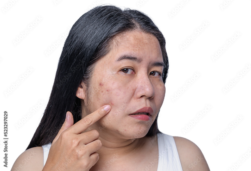 Asian adult woman face has freckles, large pores, blackhead pimple and scars problem from not take care for a long time. Skin problem face isolated white background. Treatment and Skincare concept Asian adult woman face has freckles, large pores, blackhead pimple and scars problem from not take care for a long time. Skin problem face isolated white background. Treatment and Skincare concept