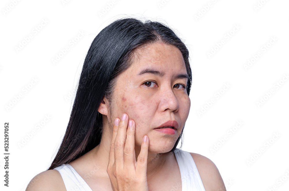 Asian adult woman face has freckles, large pores, blackhead pimple and scars problem from not take care for a long time. Skin problem face isolated white background. Treatment and Skincare concept Asian adult woman face has freckles, large pores, blackhead pimple and scars problem from not take care for a long time. Skin problem face isolated white background. Treatment and Skincare concept