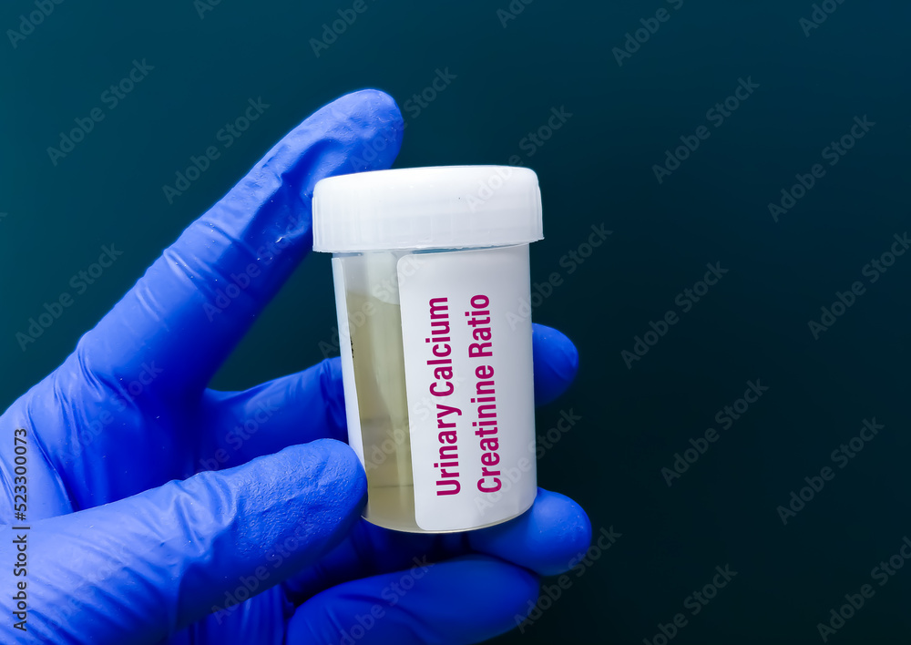 Scientist Holding Sample Container With Urine Sample For Urinary urine-test-to-look-for-abnormalities-from-urine-urine-sample-to