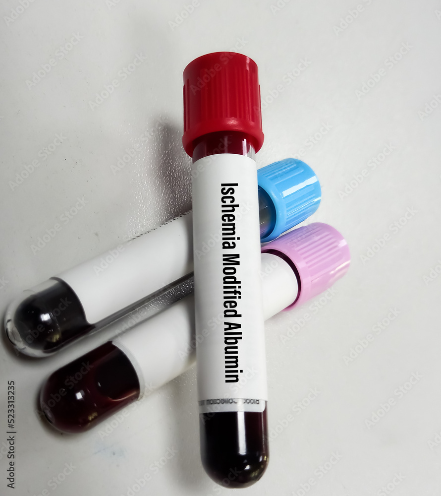 Blood sample for Ischemia modified albumin (IMA) test, a marker of