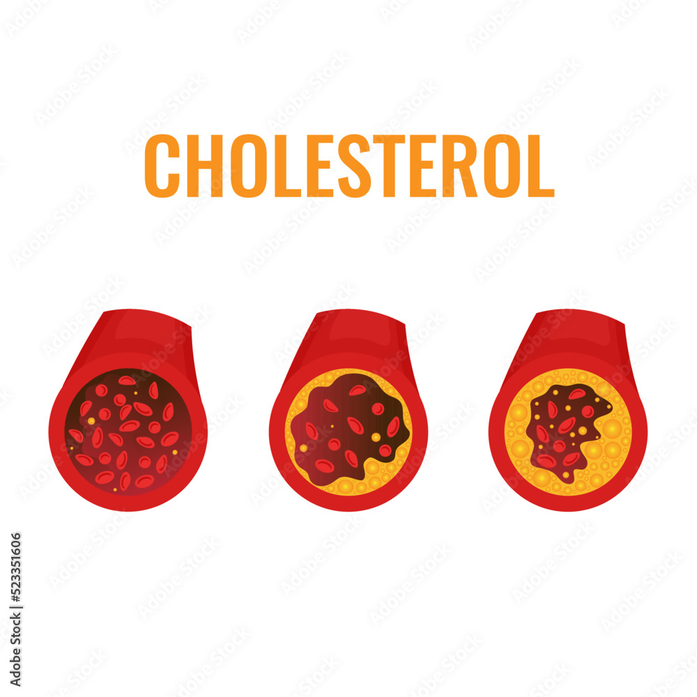 Cholesterol plaque in blocked blood vessel medical diagram. ldl and hdl lipoprotein in artery