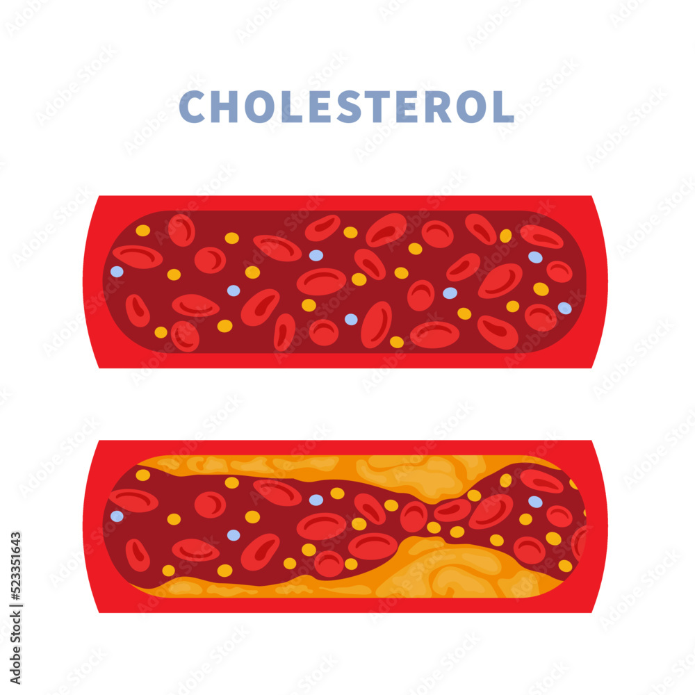Normal blood vessel versus artery with cholesterol plaque buildup