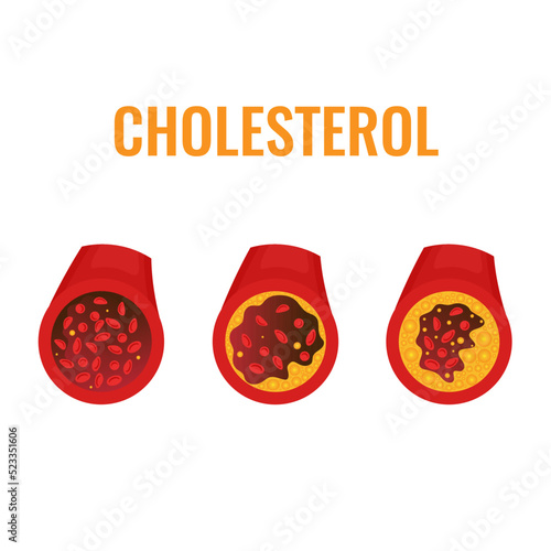 Cholesterol plaque in blocked blood vessel medical diagram. ldl and hdl lipoprotein in artery. Atherosclerosis stages and thrombus risk test indicator. Healthcare concept. Vector illustration.