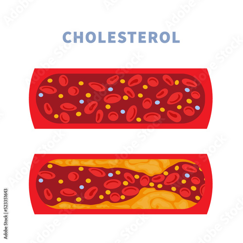 Normal blood vessel versus artery with cholesterol plaque buildup. Narrowed blood vein blocked with a clot. High cholesterol level as atherosclerotic risk. Medical concept. Vector illustration.