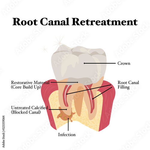 Cross section of Teeth anatomy.Root Canal Retreatment procedure on white background.Vector isolate flat design of representatives for dentist education understanding Root Canal therapy.