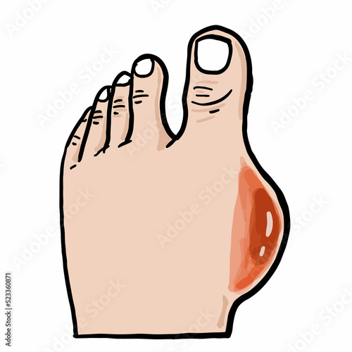 cartoon feet with high uric acid Origin of gout