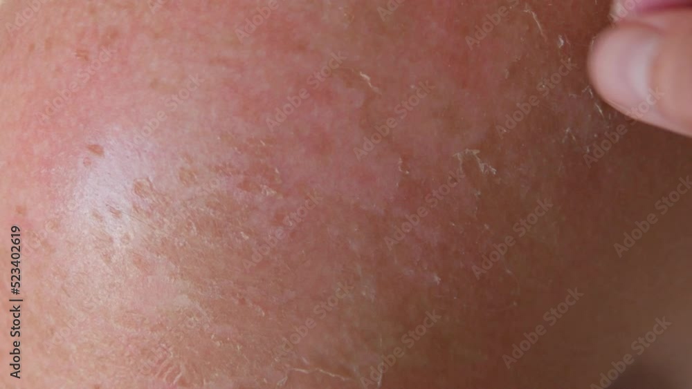 Sunburn: Closeup of Peeling sunburned skin on back and shoulder. Skin peels off after the strong sun. The hand helps to peel off the burnt skin from a sunburn. Sunburn: Closeup of Peeling sunburned skin on back and shoulder. Skin peels off after the strong sun. The hand helps to peel off the burnt skin from a sunburn.