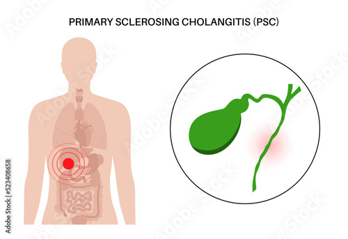 Primary sclerosing cholangitis photo