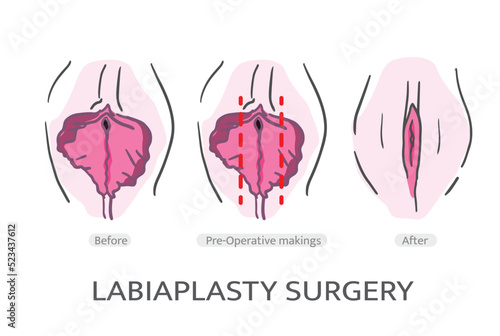 LABIAPLASTY surgery TECHNIQUES. Labiaplasty Vector. Types of female labia photo