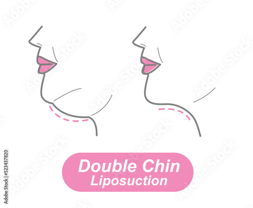 Double Chin Liposuction , liposuction vector