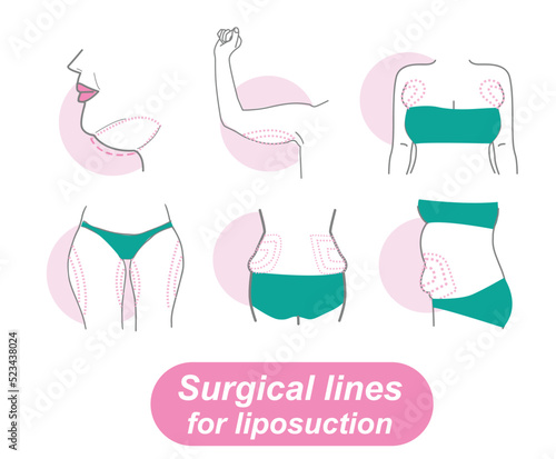 Surgical lines for liposuction illustrator EPS10