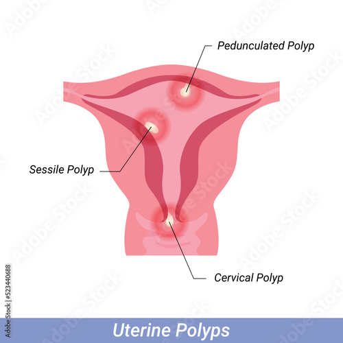 Polyps in the uterus Female reproductive system. Human anatomy internal organs