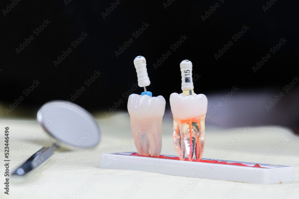 dental endodontics  - obrazy, fototapety, plakaty 
