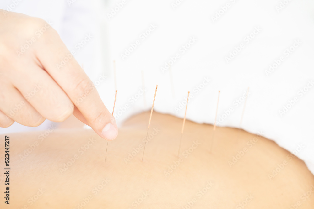 Close up of hand of doctor inserting acupuncture needle on back of patient. - obrazy, fototapety, plakaty 