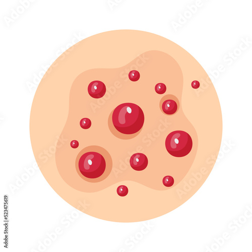 Educational banner. Allergy rash symptom cartoon vector illustration