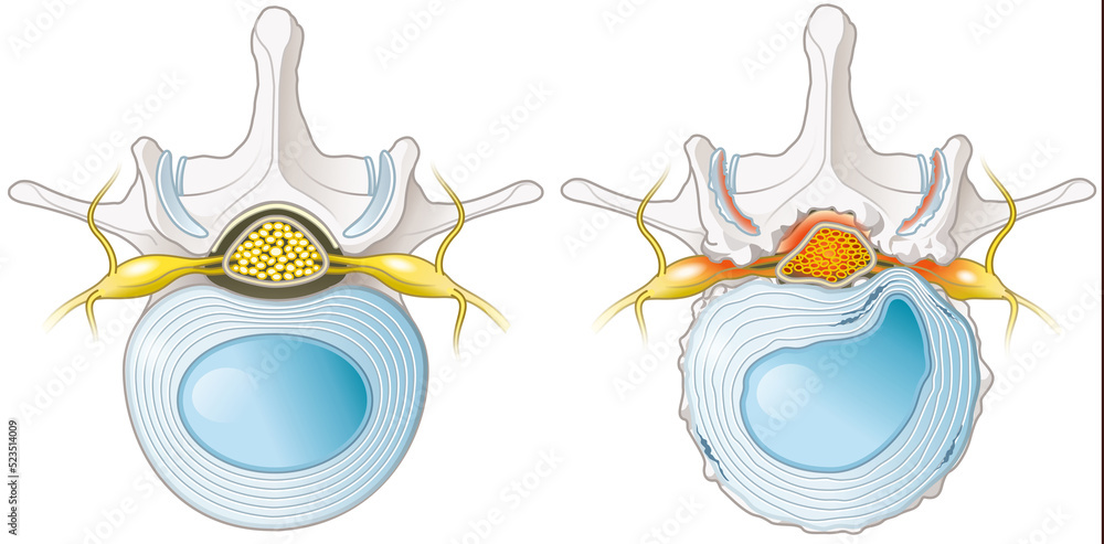 Spinal Canal Stenosis. Lumbar vertebra with intervertebral disc and herniated nucleus pulposus, illustration Spinal Canal Stenosis. Lumbar vertebra with intervertebral disc and herniated nucleus pulposus, illustration