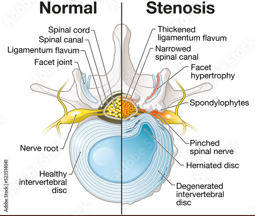 Spinal Canal Stenosis. Lumbar vertebra with intervertebral disc and herniated nucleus pulposus, illustration photo