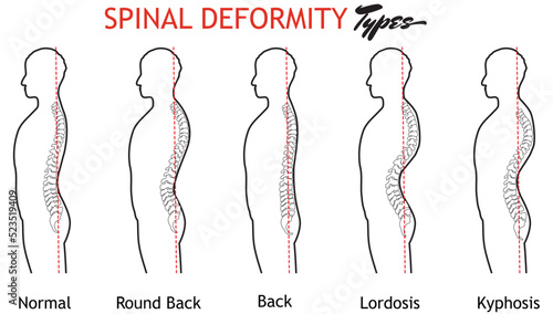 Medical poster demonstrating types of scoliosis on white background. Illustration of healthy and diseased spine, banner design photo