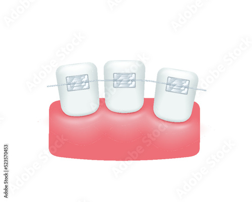 Teeth before braces. Orthodontic treatment style elements. White teeth with metal brackets