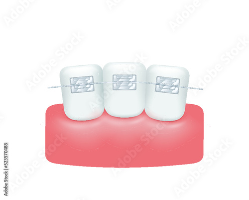 Beautiful straight teeth after braces. Orthodontic treatment style. White teeth with metal brackets