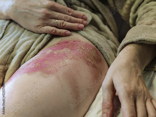 A large burn wound on the thigh. Injury from water burn, steam. Severe pain. A large area. Damaged skin on the leg.