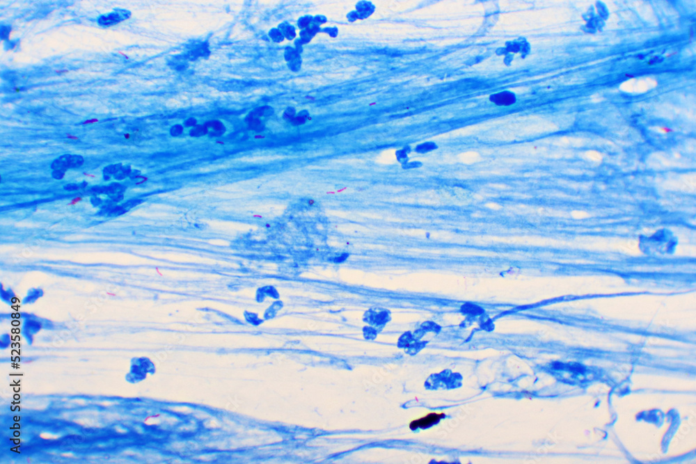 Mycobacterium tuberculosis positive (small red rod) in sputum smear, acid-fast stain, analyze by microscope 1000x Mycobacterium tuberculosis positive (small red rod) in sputum smear, acid-fast stain, analyze by microscope 1000x