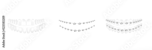 Dental braces on teeth and separate set, realistic vector illustration isolated.