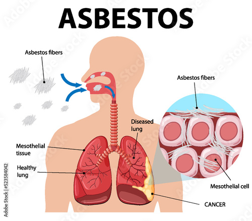 Diagram showing asbestosis in lungs