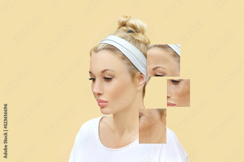 Hyperpigmentation: chloasma, melasma , age spots,Post-inflammatory hyperpigmentation.Hyperpigmentation removal Hyperpigmentation: chloasma, melasma , age spots,Post-inflammatory hyperpigmentation.Hyperpigmentation removal