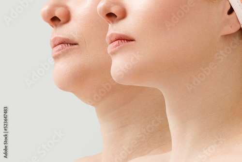 A close portrait of an aged woman before and after the facelift procedure. The result of facial rejuvenation and wrinkle smoothing in a cosmetology clinic. photo